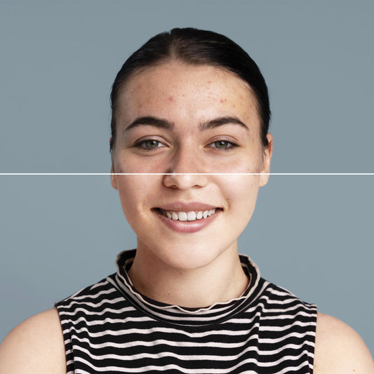 3 Ways to Treat Acne Marks