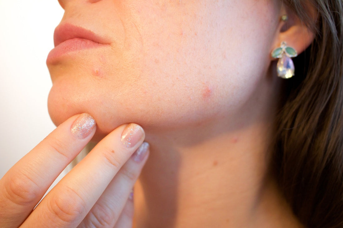 Do You Have Blackheads Or Are They Sebaceous Filaments?