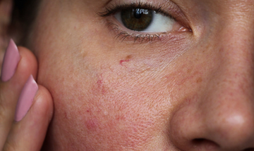 Did you over-exfoliate? Here's how to treat it