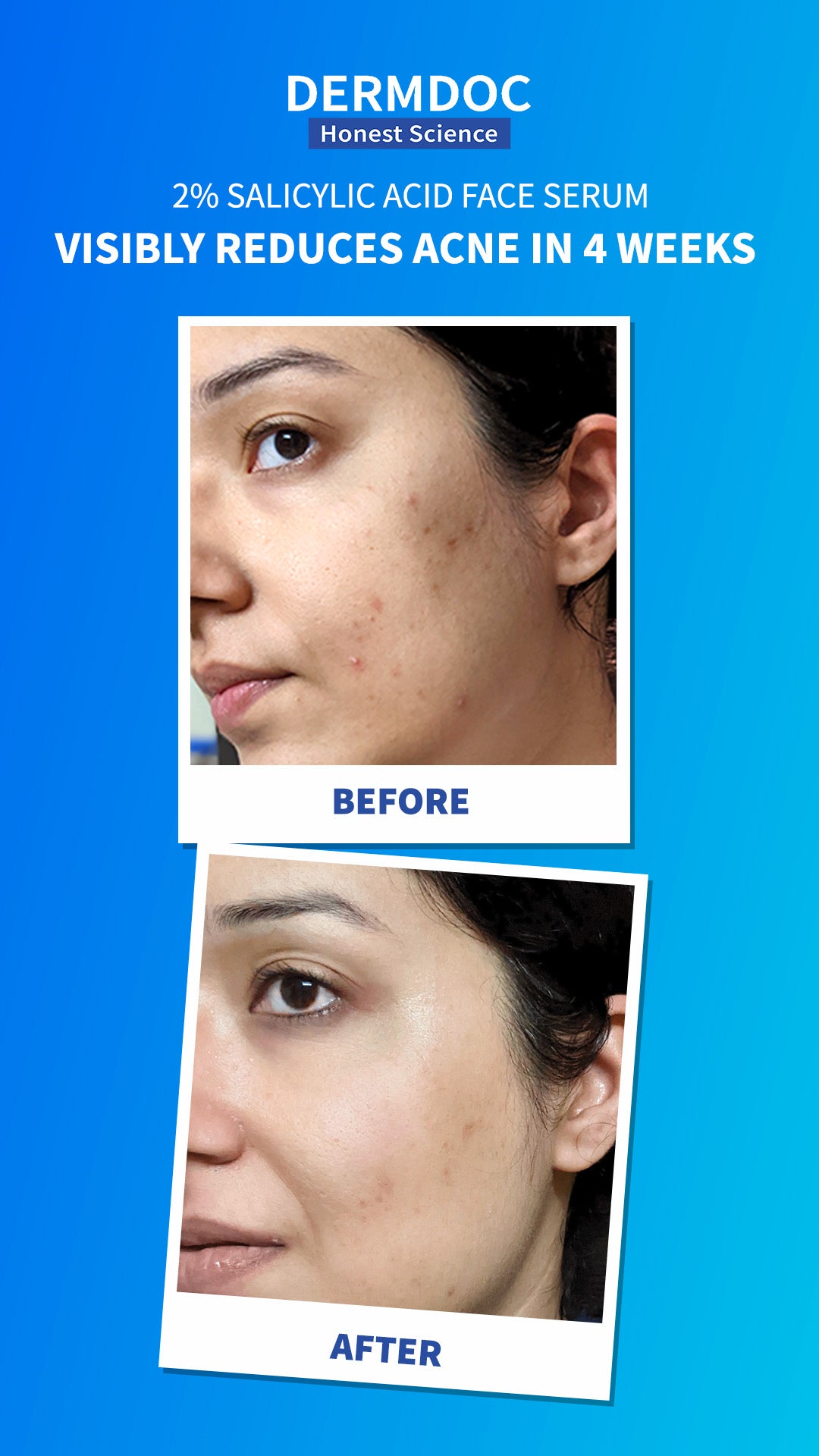 best serum for pimples India