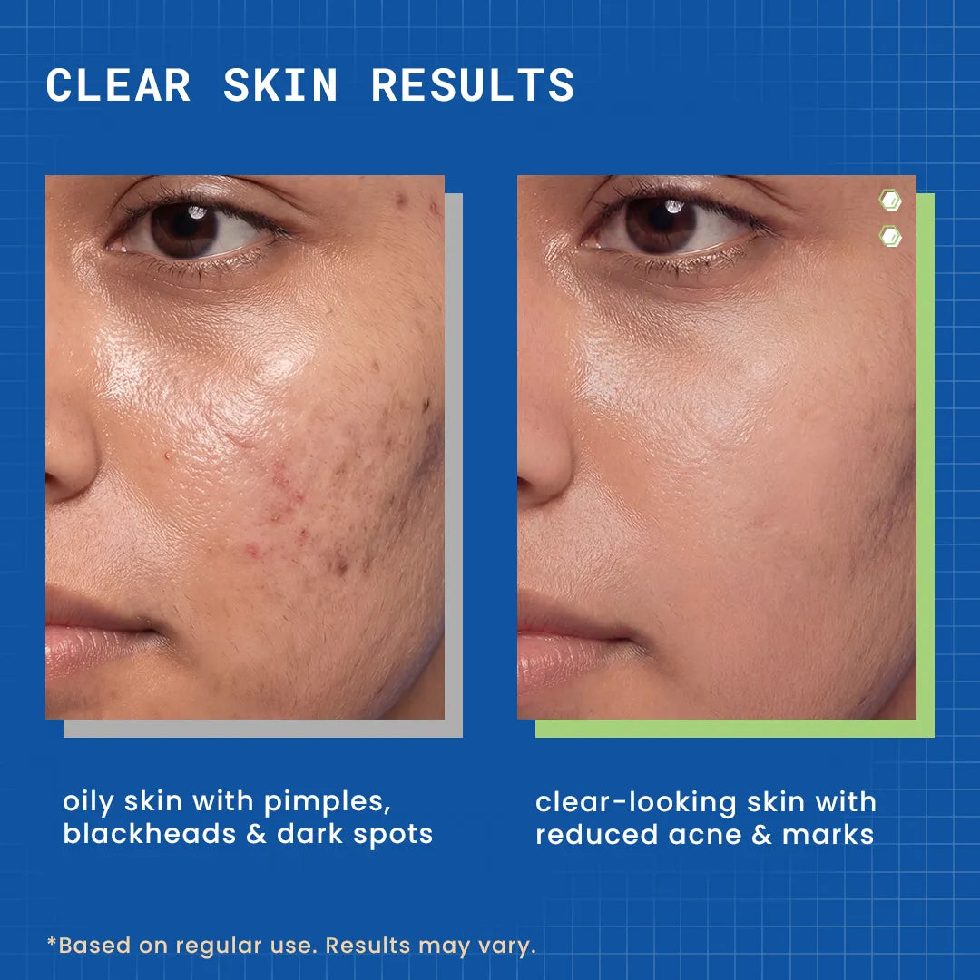 DERMDOC 2% Salicylic Acid Face Wash