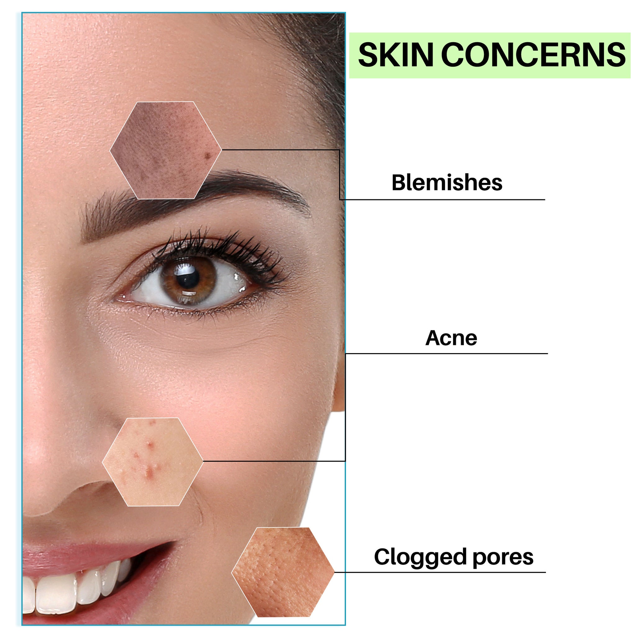 BuyBlemish Clearing Face Toner with Salicylic Acid and Milk Protein